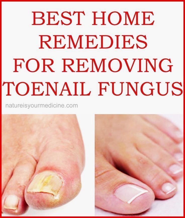 Will Removing Toenail Get Rid Of Fungus