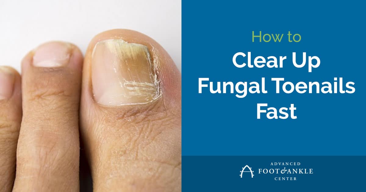 Worst Case Of Toenail Fungus