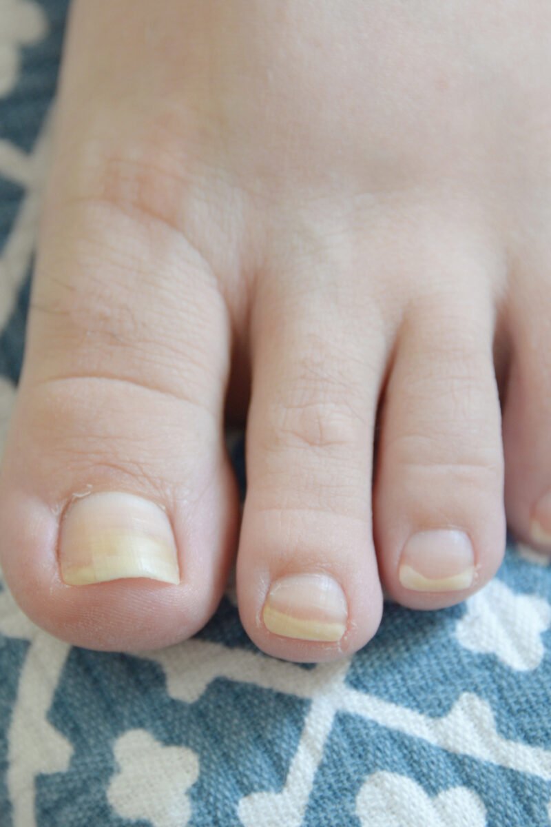 Yellow Toenails: Causes, Prevention, and Treatments