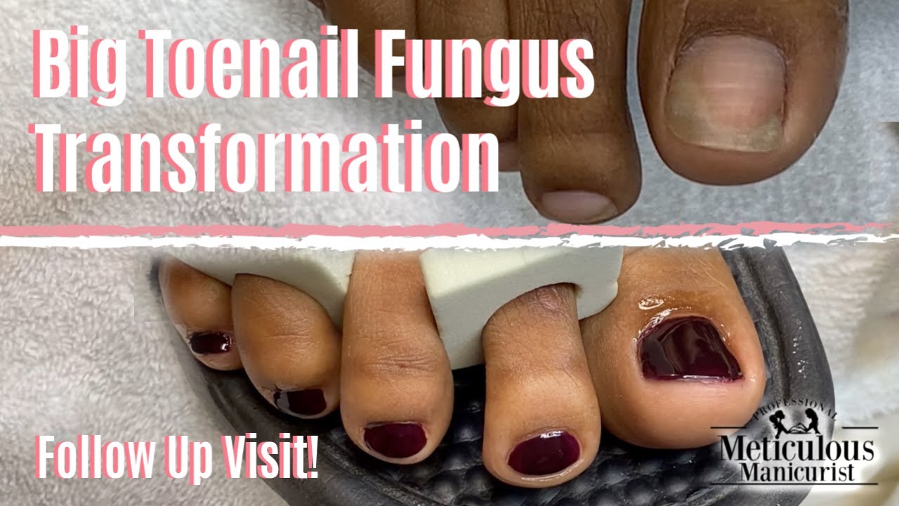 ð£How To Pedicure Toenail Fungus Cleaning Part 2ð£
